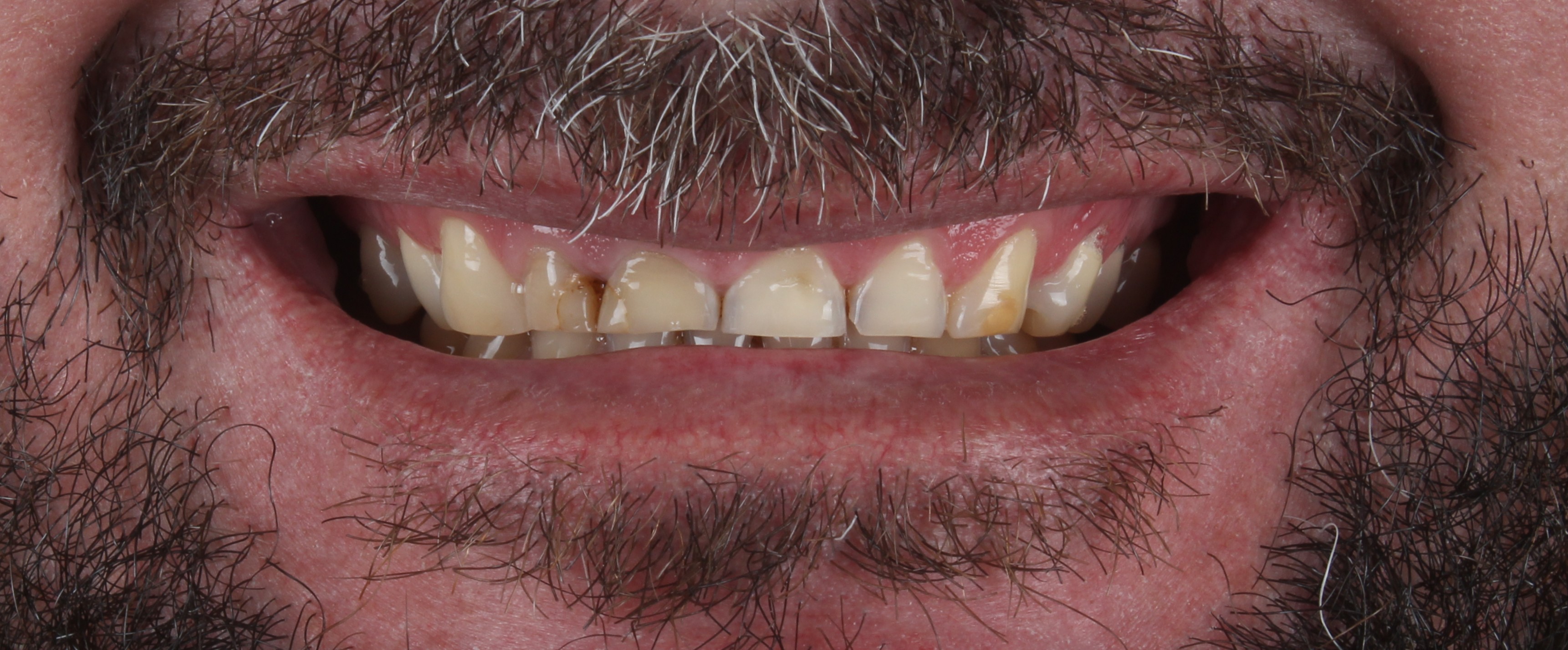 Antes das facetas de resina